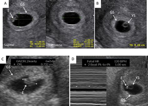 Early pregnancy ultrasound measurements and prediction of.